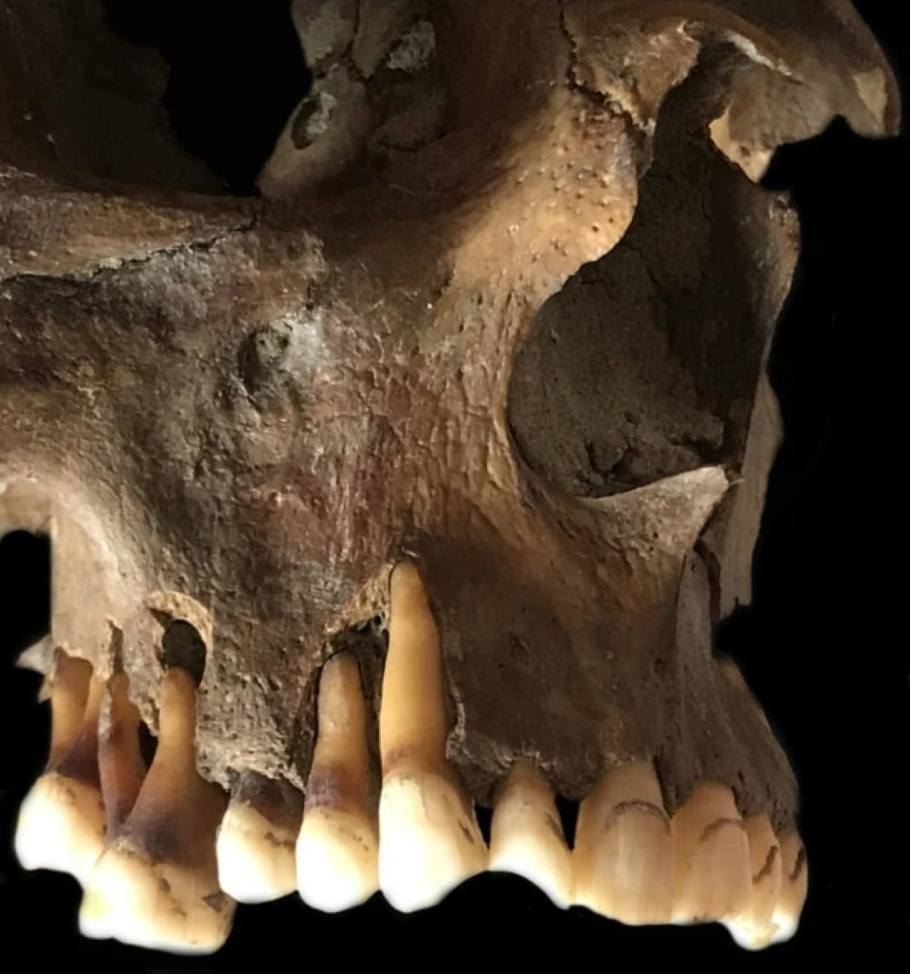 Teeth and skull of a young adult male from 17th century Holland. One of the samples of ancient herpes DNA used in the study came from a male 26-35 years old, excavated near the banks of the Rhine. The man was a fervent smoker of clay pipes. Traces of the habit are visible in multiple places on the teeth, where the hard clay pipe, usually put in the same place in the mouth, has worn the teeth - Image Credit: Dr. Barbara Veselka.