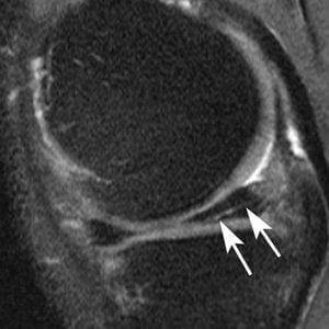 This sagittal intermediate-weighted fat-saturated image shows a typical horizontal-oblique meniscal tear of the posterior horn reaching the undersurface of the meniscus. Credit: RSNA