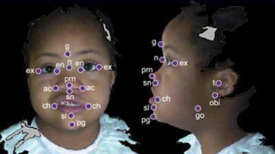 3D Facial Scans Aid Diagnosis of Children with Phelan-McDermid Syndrome Article.