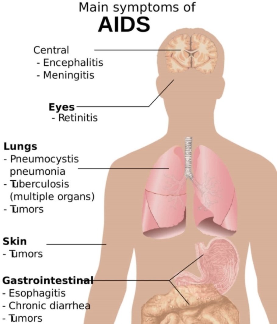 Labeled diagram outlining the main symptoms of AIDS.
