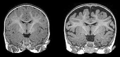 Right: MRI of a baby at 6 months who was diagnosed with autism at 2 years. The dark space between the brain folds and skull indicate increased amounts of cerebrospinal fluid. Left: MRI of a baby who was not diagnosed with autism at age 2. Note the decreased amount of CSF. Image Credit: Carolina Institute for Developmental Disabilities (UNC-Chapel Hill)
