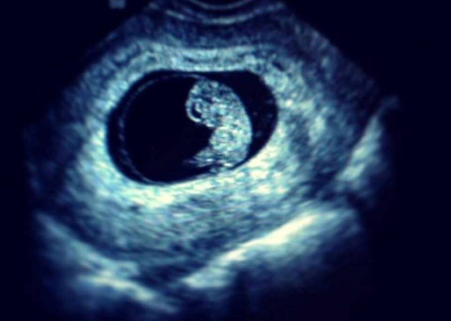 Ultrasound image of baby in womb.