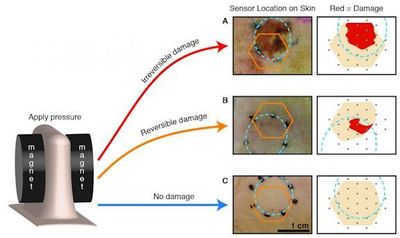 Researchers varied the amount of pressure applied to the skin, creating bedsores ranging in severity. The orange hexagon marks where the bandage was placed on the skin, and the dotted blue circle highlights where pressure was applied to the tissue. The reversible damage example highlights sensitivity of the smart bandage impedance sensor since the wound is not visible at the surface of the skin. Courtesy of UC Berkeley.