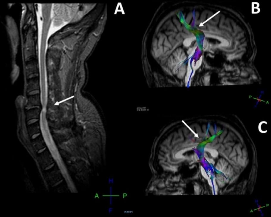 How people with spinal cord injuries (SCI) can also have brain damage (TBI). Scan reveals cerebral alterations.
