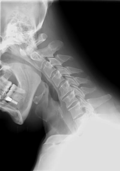 X-ray of cervical spine (neck) in flexion (bending forward). There is no evidence of fracture, bone destruction, or malalignment. There are degenerative bone and is changes at C5-6. There is no evidence of cervical instability on the flexion and extension views. The facet joints are well aligned. Bony spurring is narrowing the C5-6 neural foramina bilaterally.
