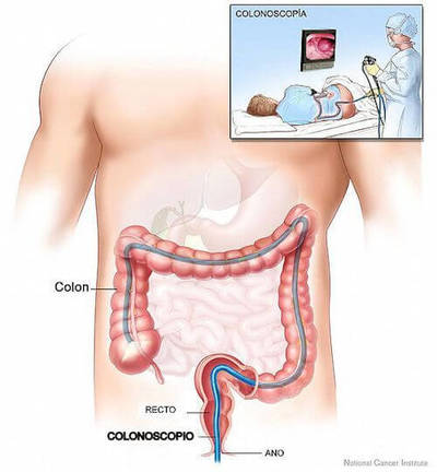 Diagram with inset showing overview of colonoscopy procedure