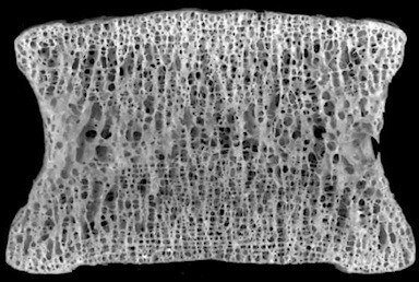 Can a diet high in processed fat and sugar and type 2 diabetes cause degeneration of intervertebral discs in the spine? Image Credit: Rensselaer Polytechnic Institute