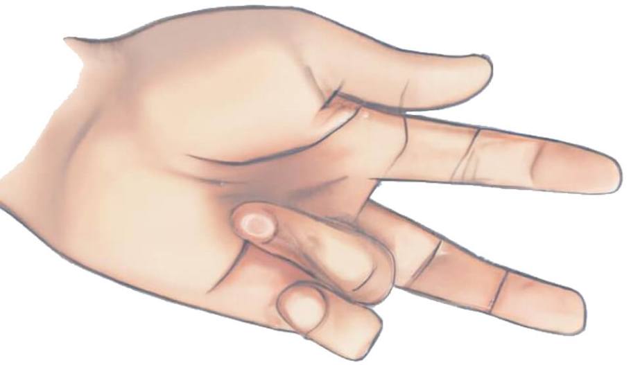 A ring finger locked in a bent position as seen in Dupuytren's disease, colloquially known as the Viking disease - Image Credit: Hugo Zeberg - Molecular Biology and Evolution.
