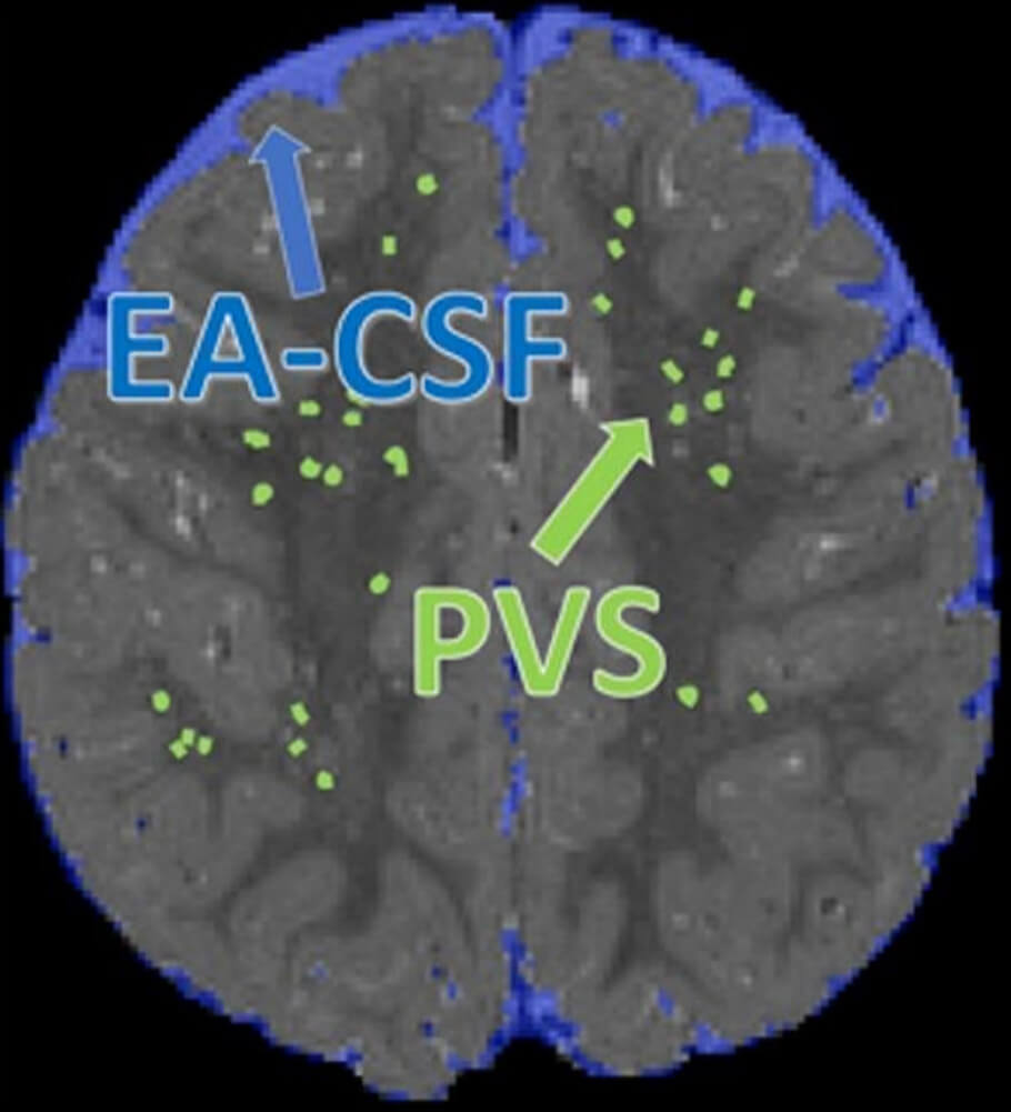 Extra-axial cerebrospinal fluid (EA-CSF) and perivascular space (PVS) segmentation on 24-month scan of a child who was diagnosed with autism - Image Credit: Dea Garic and Mark Shen.