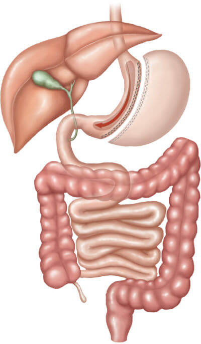 Illustration of the human digestive system showing Gastric bypass sleeve - gastrectomy.