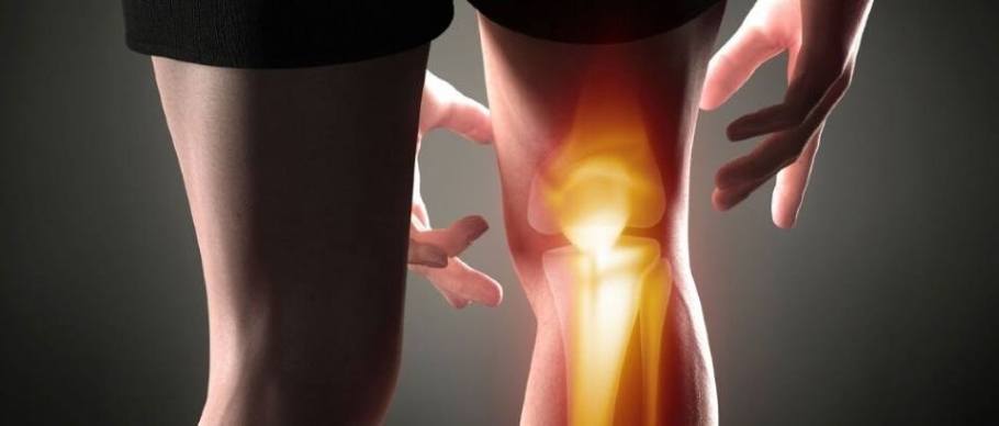 Illustration of knee osteoarthritis.