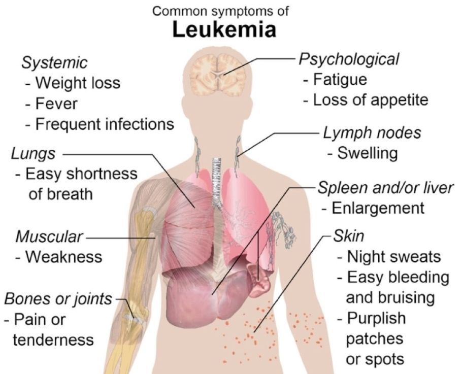 Labeled diagram outlining the symptoms of leukemia.