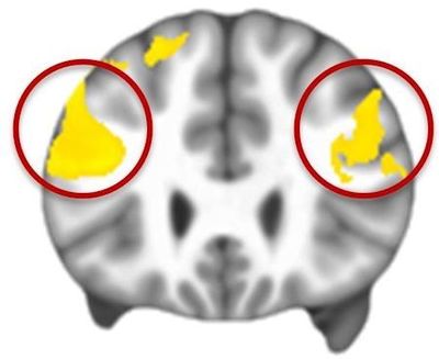 MRI data composite: the yellow indicates the prefrontal cortex areas that are significantly underactive in people with autism while regulating their emotions. (Gabriel Dichter, Ph.D., UNC School of Medicine)