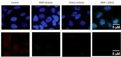 Fluorescent staining shows how PARP and CDK12 inhibitors combine to deal a lethal blow to Ewing sarcoma. In the top row, green represents locations of DNA damage incurred by Ewing sarcoma cells. In the bottom row, red represents DNA repair activity. Together, PARP and CDK12 inhibitors lead to Ewing sarcoma cell death - Image Credit: Dana-Farber/Boston Children's Cancer and Blood Disorders Center.