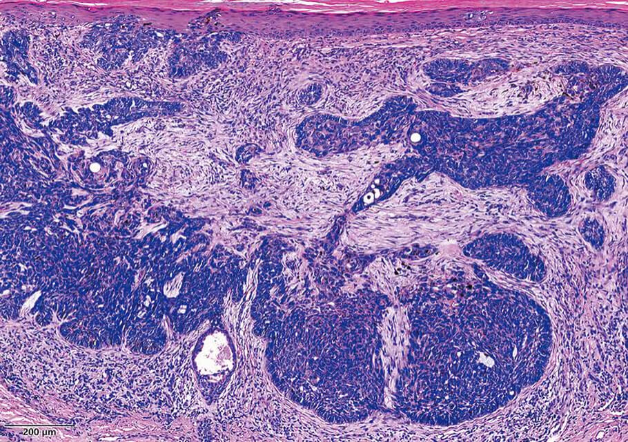 The image is a hematoxylin and eosin (H&E) stained microscopic view of skin tissue shown in shades of pink, purple, and dark blue.