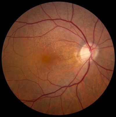 Fig 2. A fundus photo of a patient with reticular pseudodrusen shows a giraffe-like macular pattern - Image Credit: National Eye Institute (NEI).