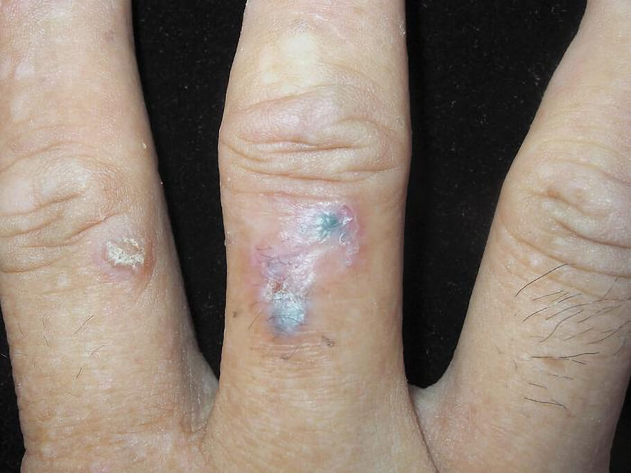 Two bluish-black nodules overlying erythema on the right middle finger.