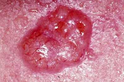 Photo of a basal cell carcinoma on the back, Basal cell carcinoma is the most common skin cancer.