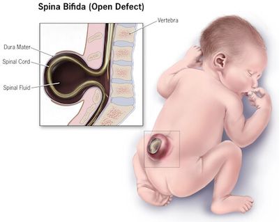 An illustration of an infant with Spina Bifida (open defect) including exploded diagram area.