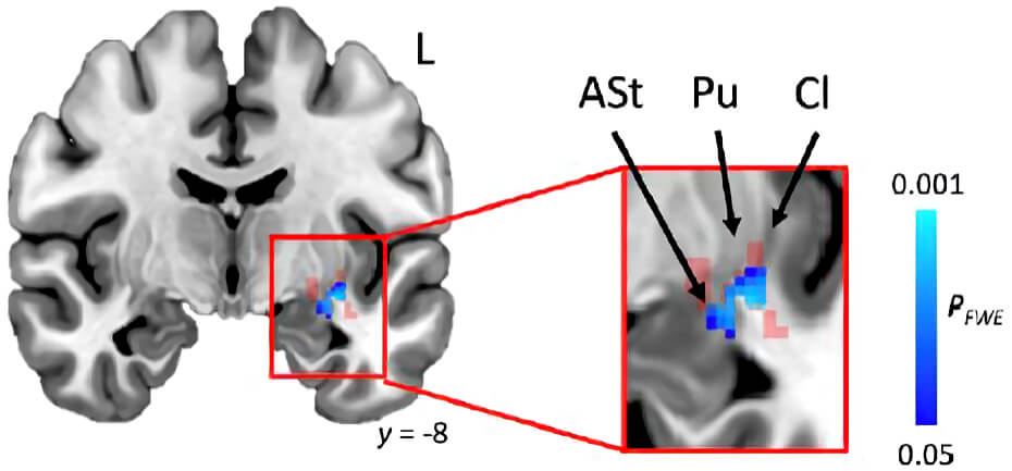 Illustration showing human brain areas related to stuttering.
