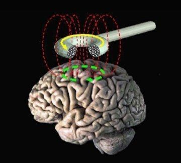 Schematic Diagram of Transcranial Magnetic Stimulation