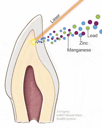 Cross-section of tooth showing laser removal of the dentine layer, in tan, for analysis of metal content.