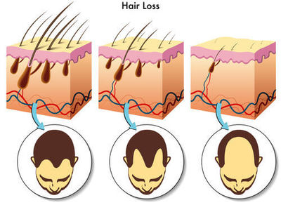 Illustration shows receding hairline on the scalp and hair follicles