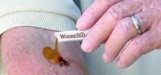 WoundSeal powder being applied to forearm